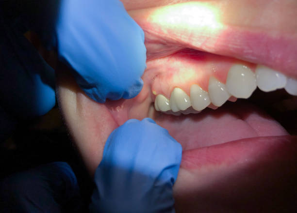Best Emergency Care for Gum Disease in Homer, GA